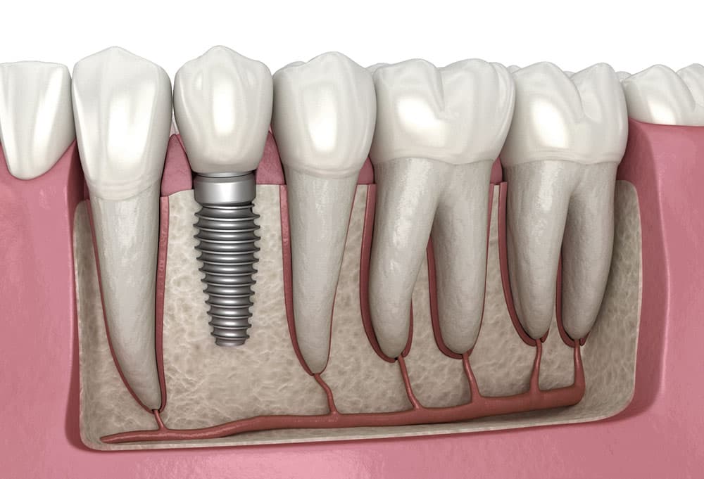 Guided vs. Freehand Implant Placement: What the Evidence Actually Says