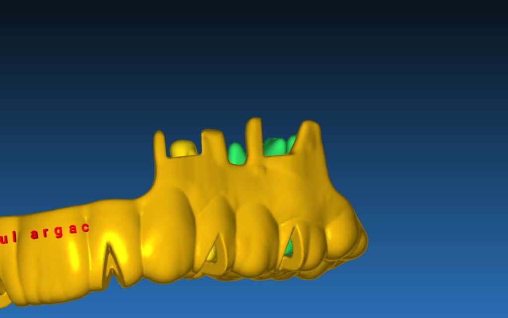 Apical Resection Case 2