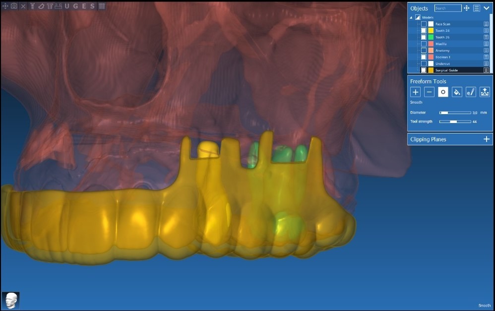 Apical Resection Case 3