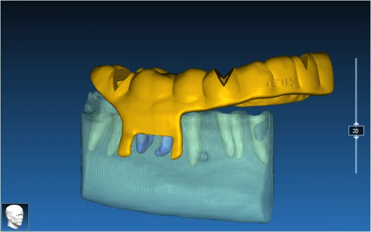 Apical Resection Case 3