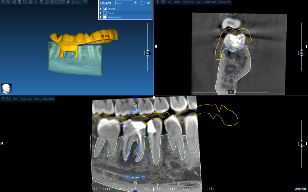 Apical Resection Case 5