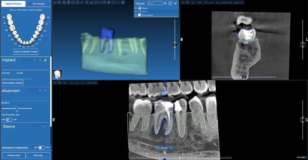 Apical Resection Case 6