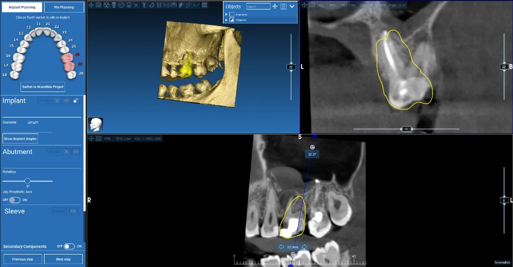 Autotransplant Case 1