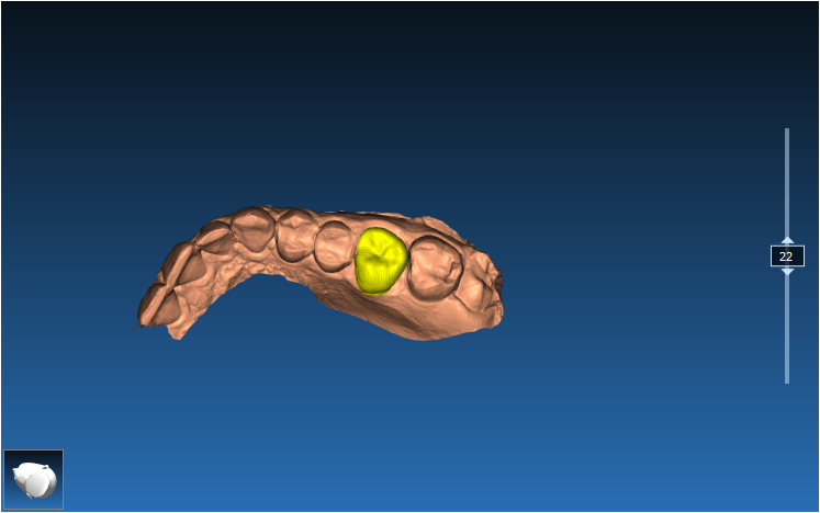 Autotransplant Case 2