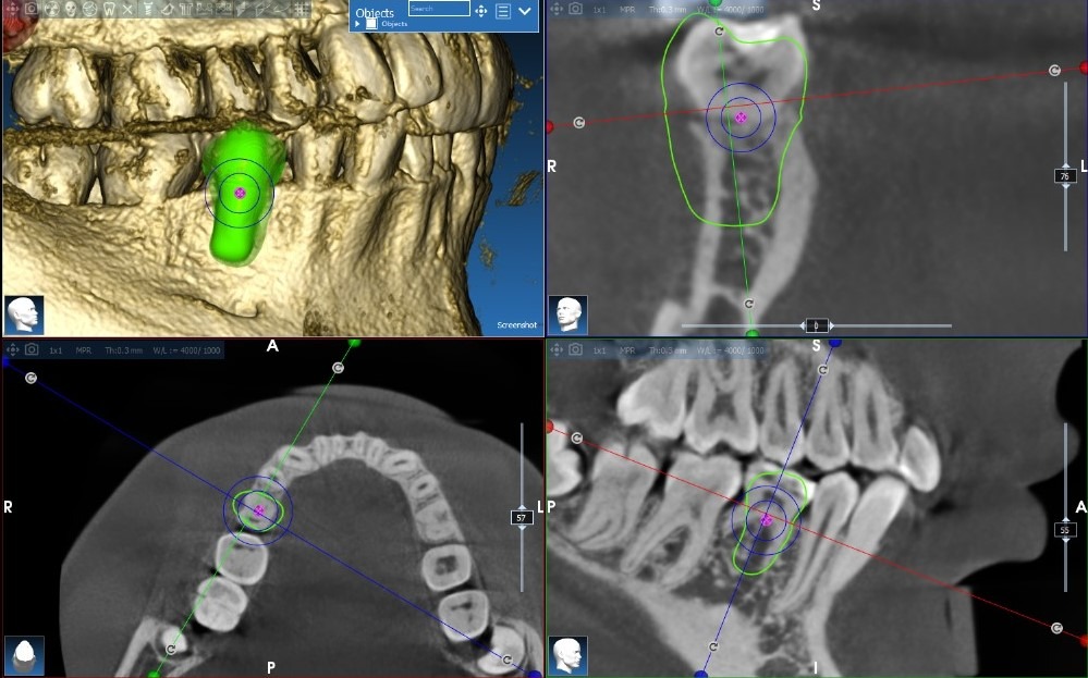 Autotransplant Case 3
