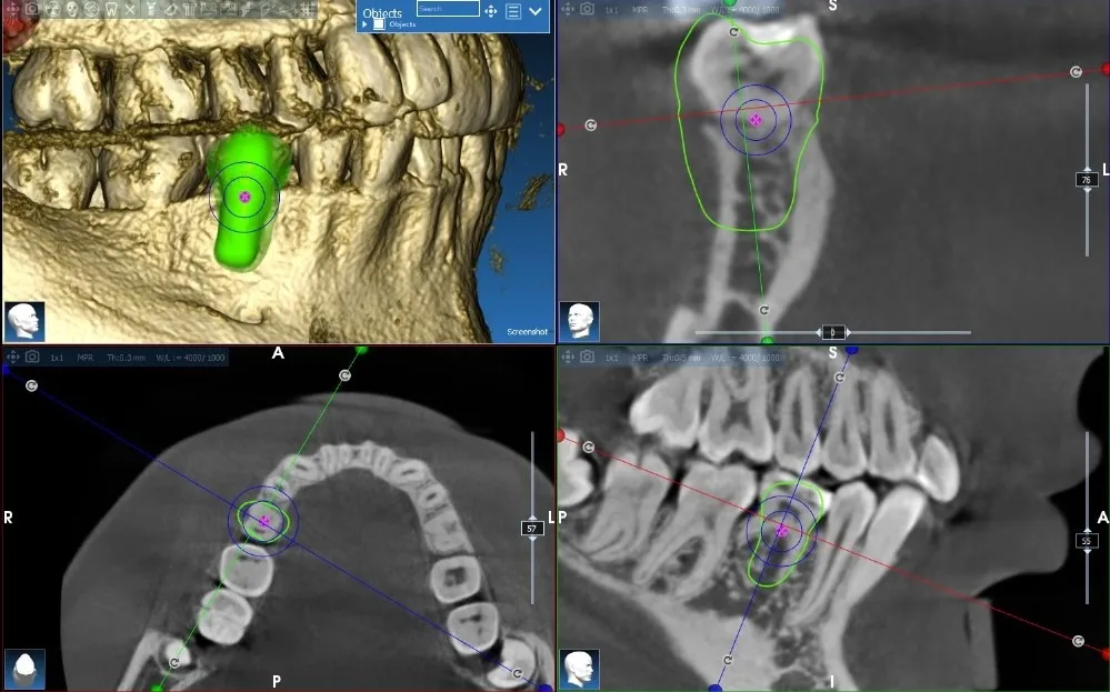 Autotransplant Case 3