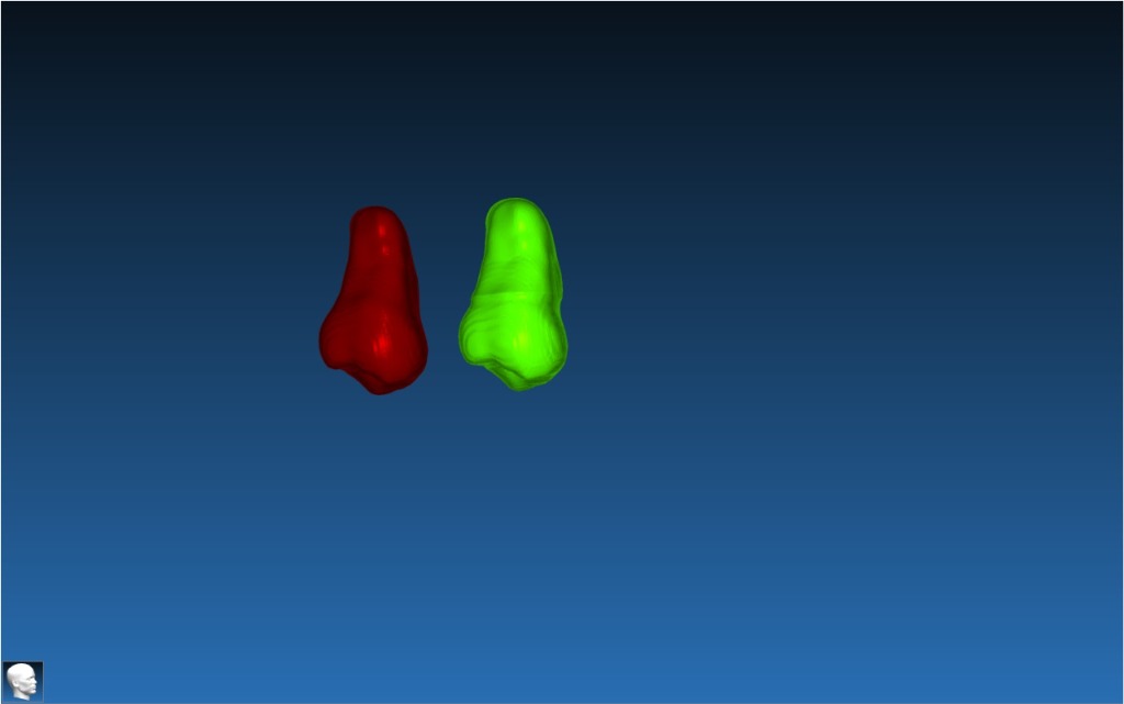 Autotransplant Case 4