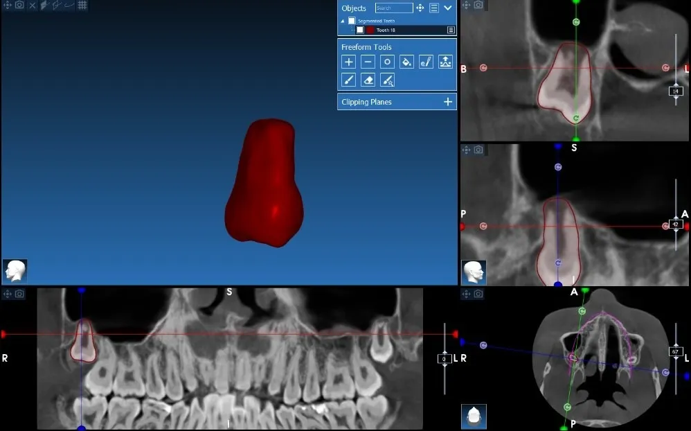 Autotransplant Case 5