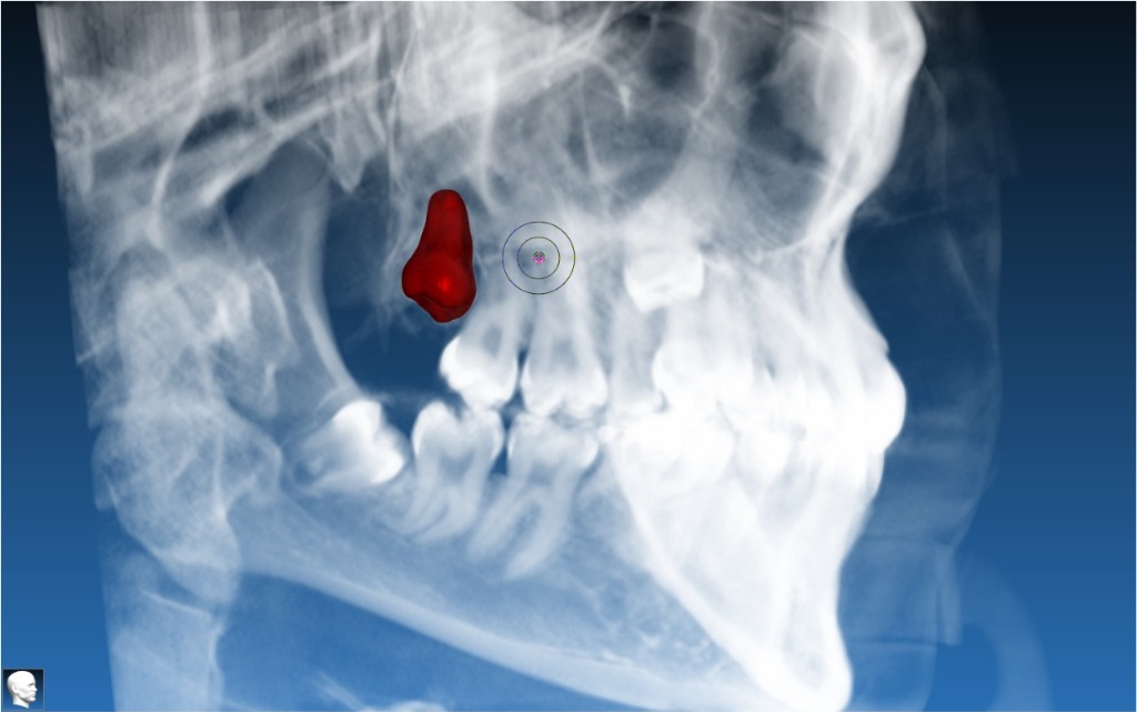 Autotransplant Case 6