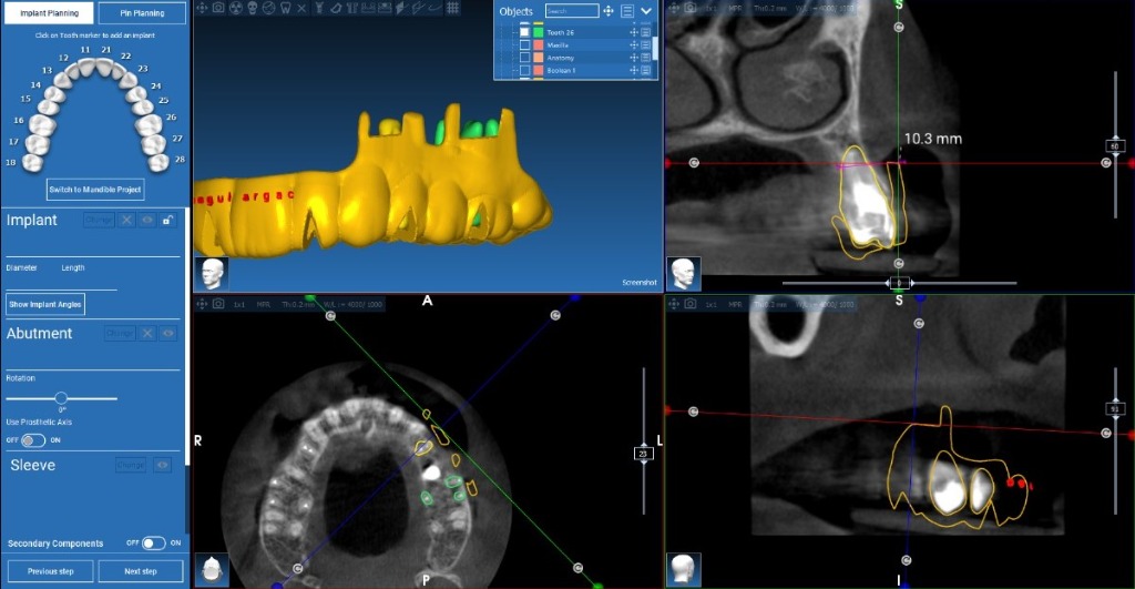 Apical Resection Case 1
