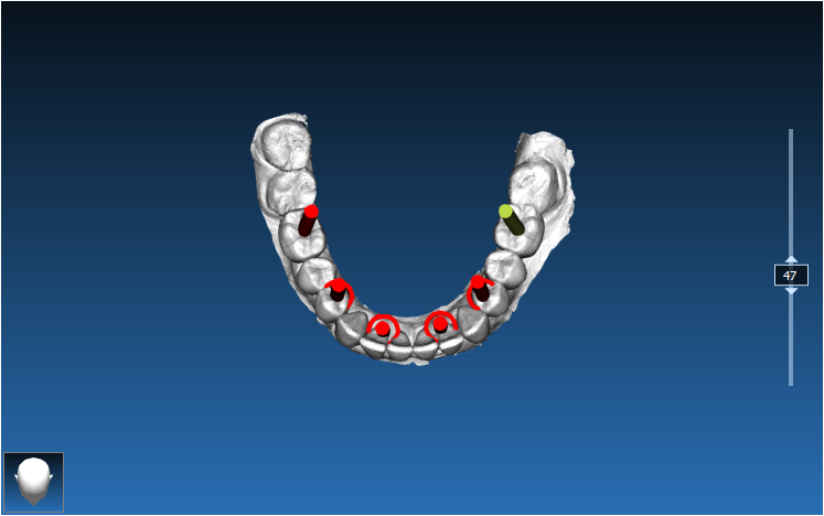 Implant Guide Case 1