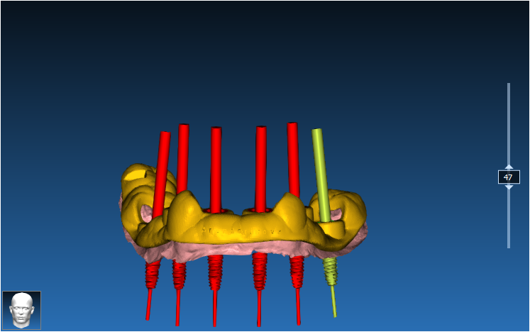 Implant Guide Case 2