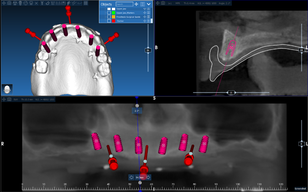 Implant Guide Case 3