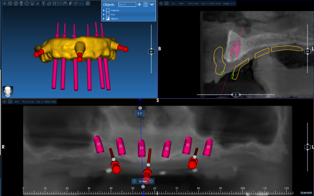 Implant Guide Case 4