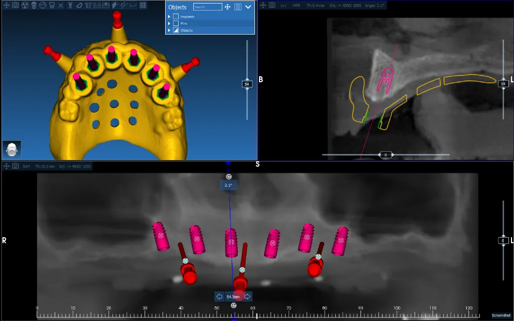 Implant Guide Case 5