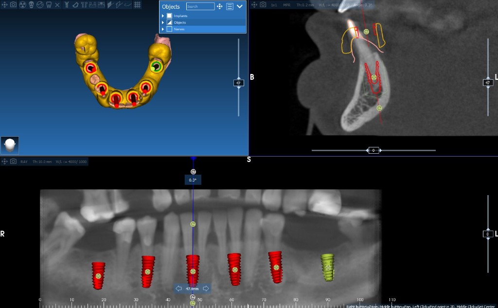 Implant Guide Case 6