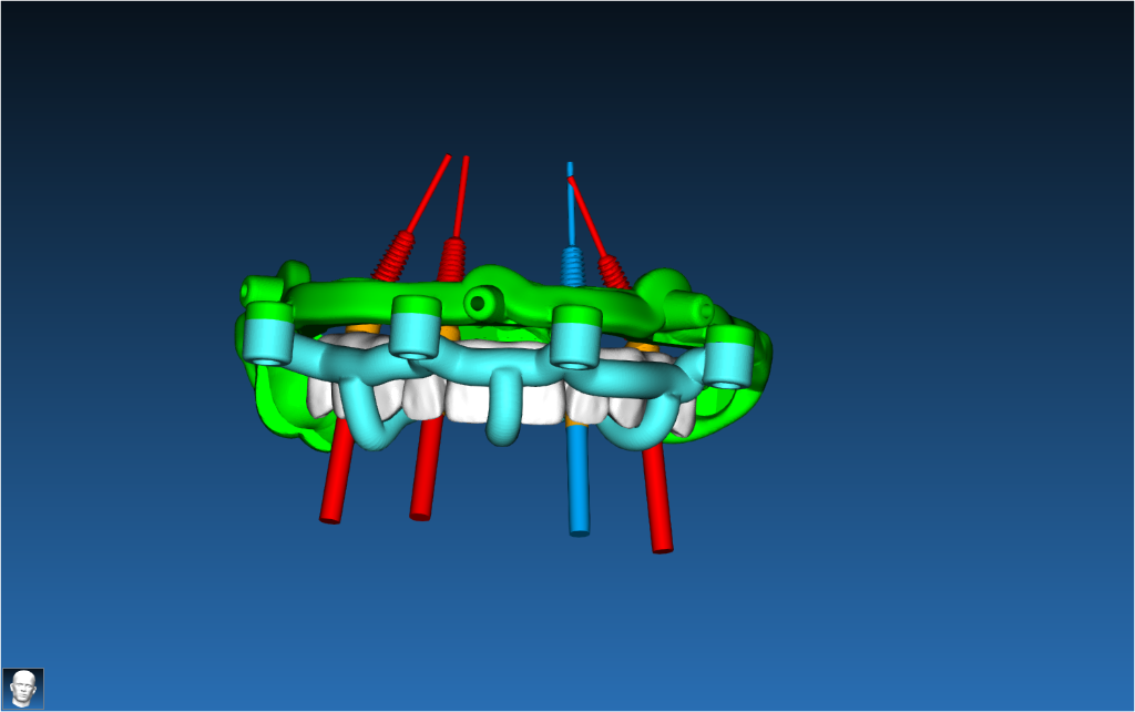 Stackable Guide Case 1
